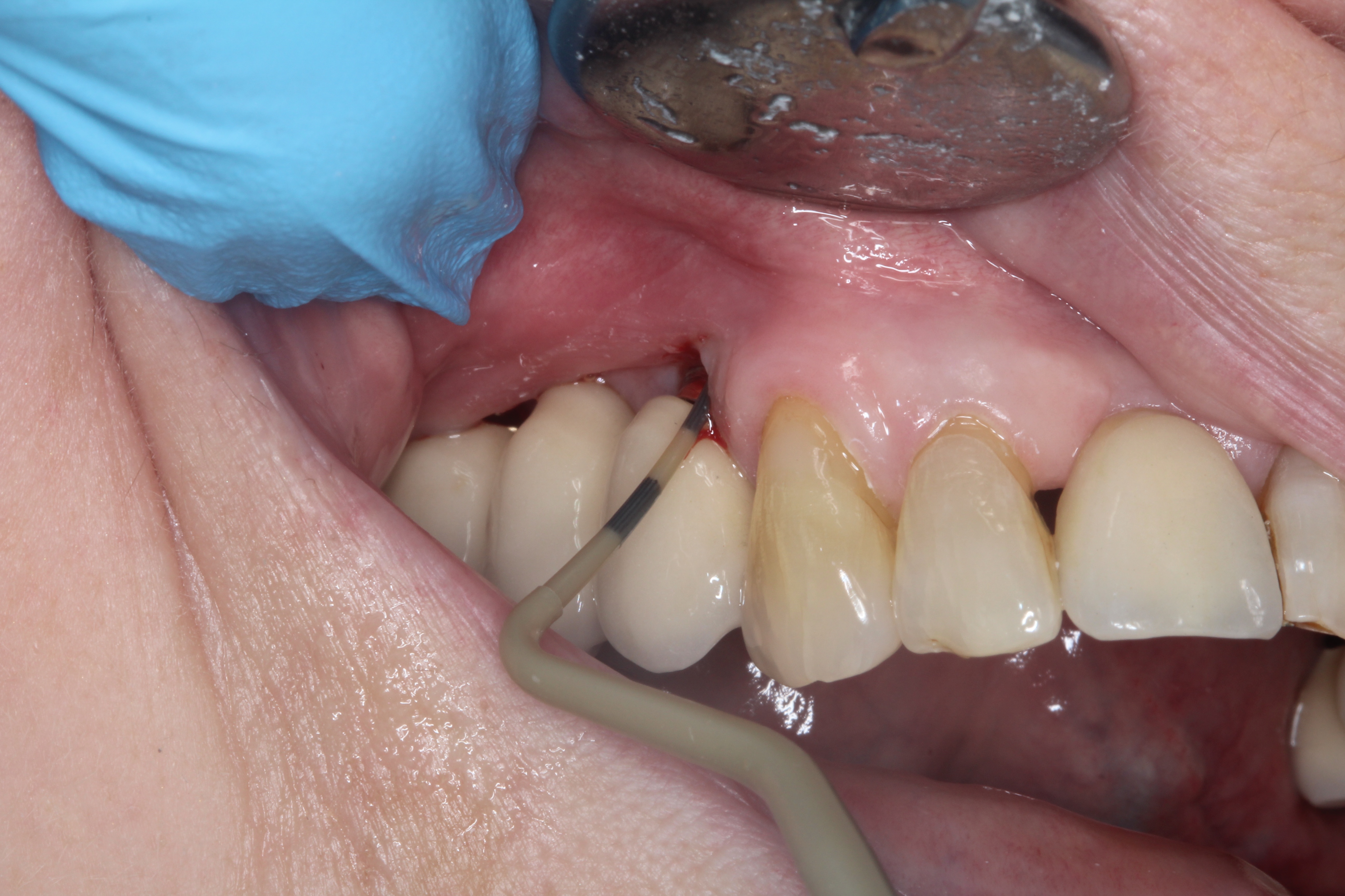 Dental Implant Health Assessment Understanding The Use Of Probing Optident
